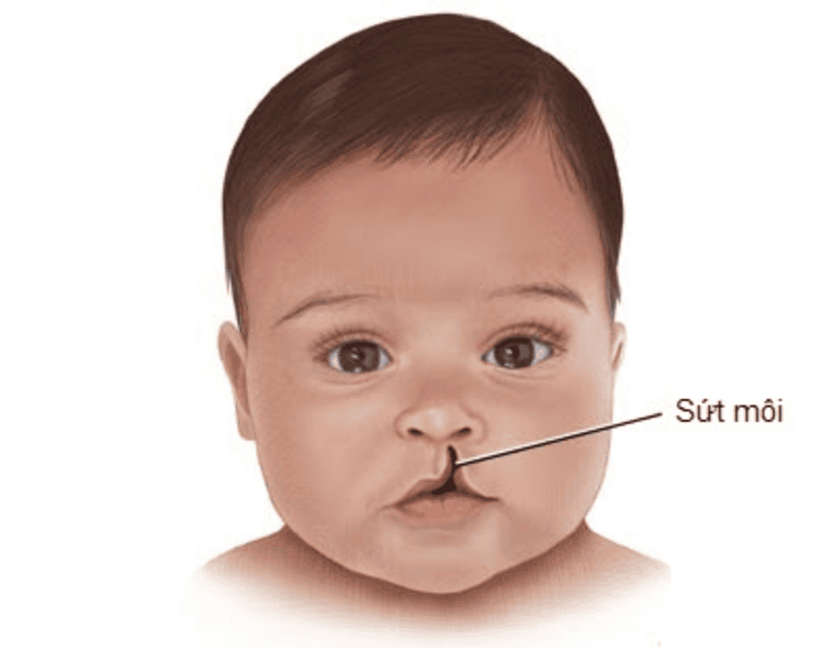 Children with Stickler syndrome are often born with a cleft palate