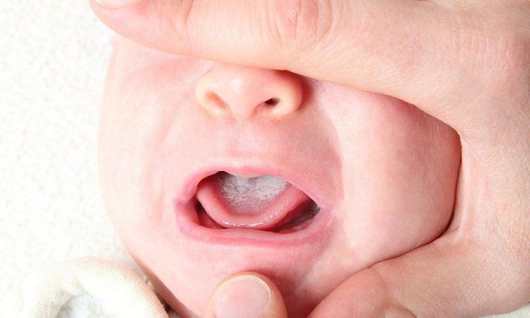 Một trong những tình trạng cần chú ý khi bé được 13 tuần tuổi là hiện tượng nấm men ở miệng