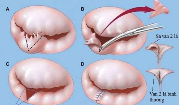 Phẫu thuật điều trị sa van 2 lá