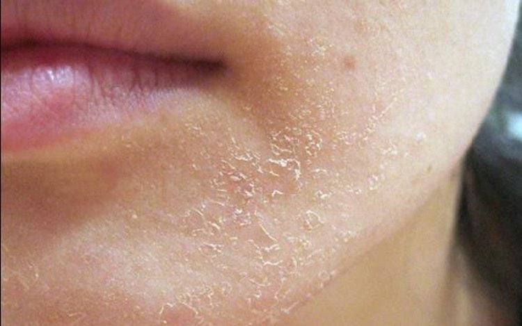 People with Dry Skin Often Experience Flakiness on the Chin During Cold Weather
