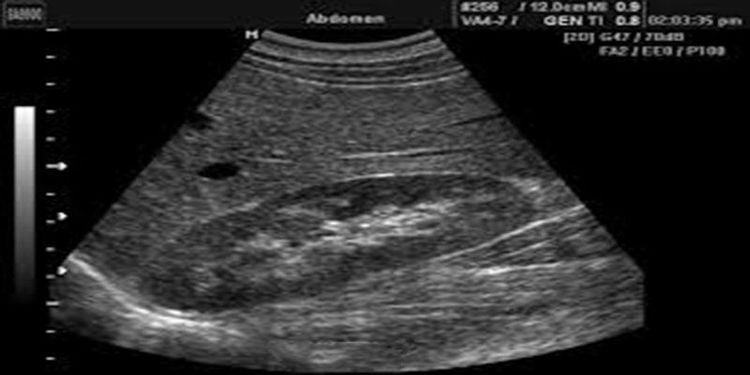 Normal Kidney Ultrasound Image