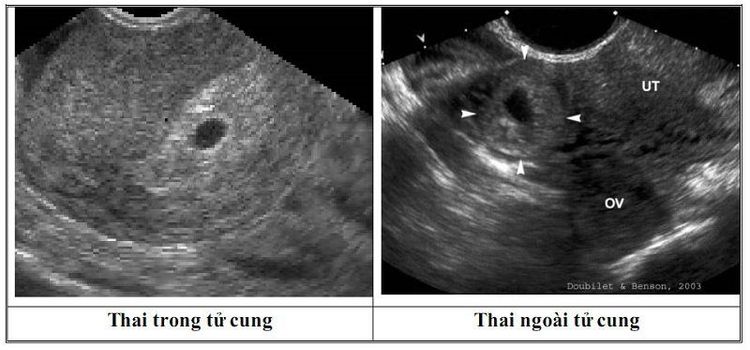 Phụ nữ hút thuốc làm tăng nguy cơ mang thai ngoài tử cung