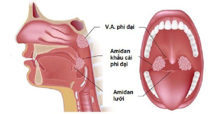 Một số loại viêm Amidan