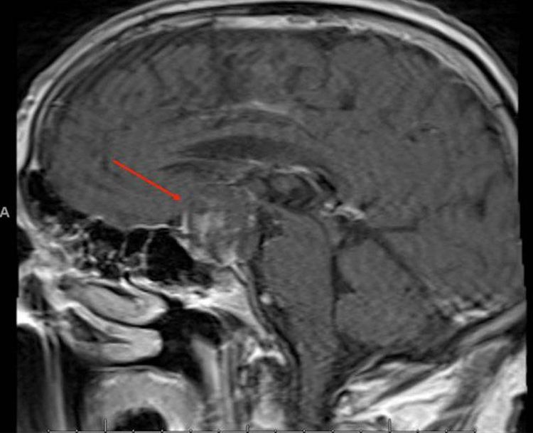Chụp MRI giúp xác định vị trí, tình trạng khối u