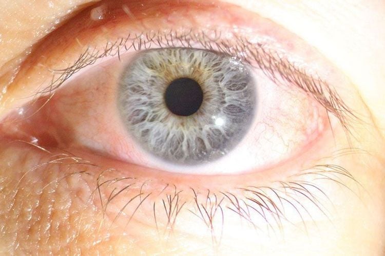Mổ lasik khiến mắt bị khô - tăng khả năng viêm nhiễm