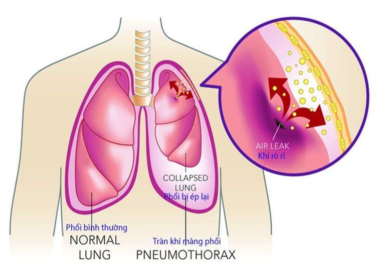 Tràn khí màng phổi tự phát thường xuất hiện đột ngột không rõ nguyên nhân