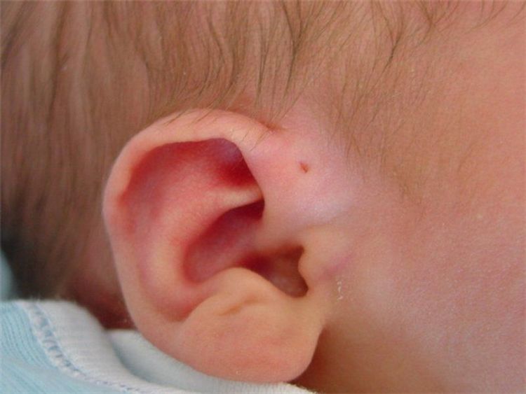 Đường rò luân được biết đến là một dị dạng bẩm sinh