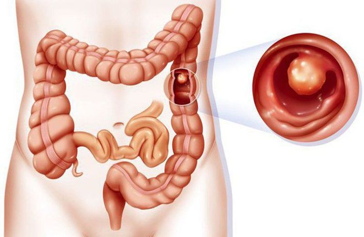 Polyp xuất hiện gây ung thư đại trực tràng