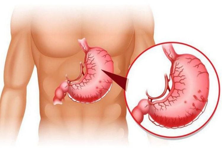 The condition of gastrointestinal bleeding can cause black, tarry stool.