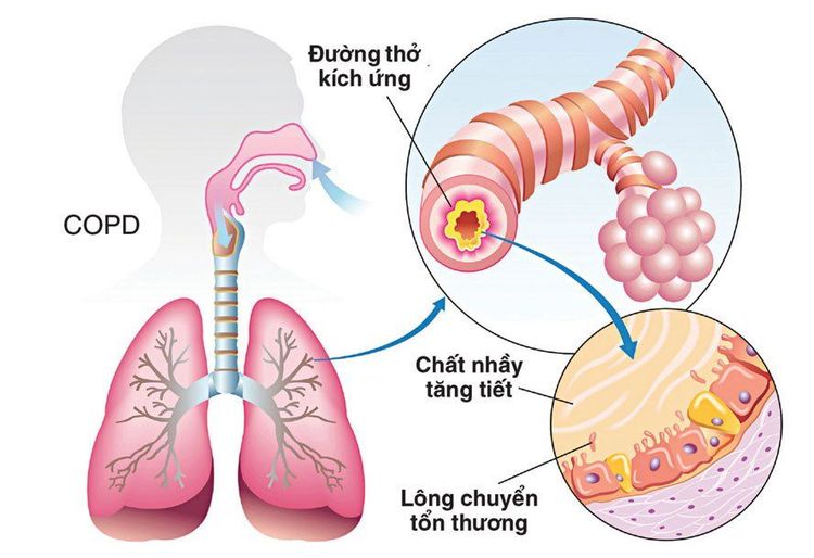 Thuốc giãn phế quản thường không có tác dụng với bệnh nhân mắc phổi tắc nghẽn mãn tính