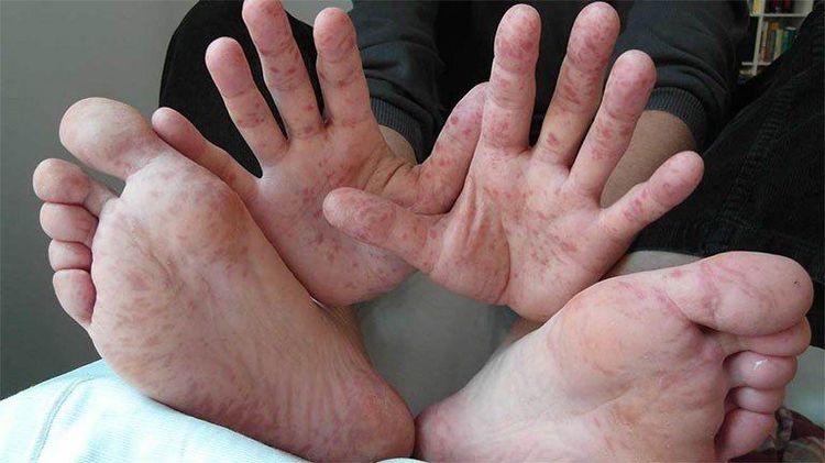 Mẩn đỏ là một trong những tác dụng phụ của thuốc