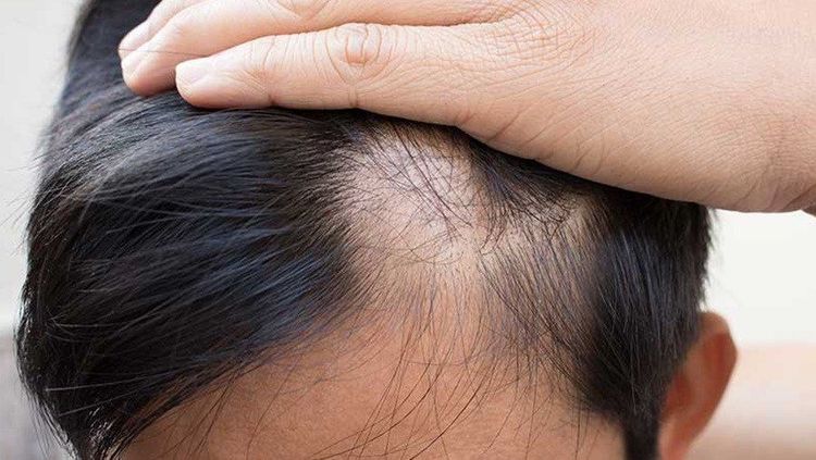 Coconut oil is used to treat male pattern baldness.