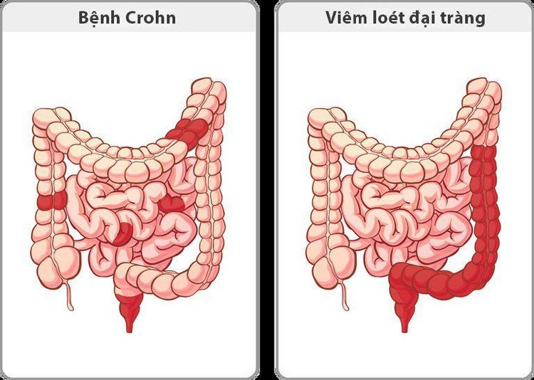 Hai dạng chính của bệnh viêm ruột