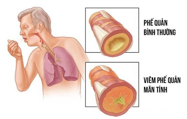 Viêm phế quản mạn tính được xem là nguyên nhân gây ra bệnh phổi tắc nghẽn mạn tính