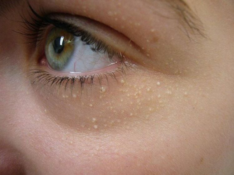 Molluscum contagiosum has external signs similar to other skin diseases