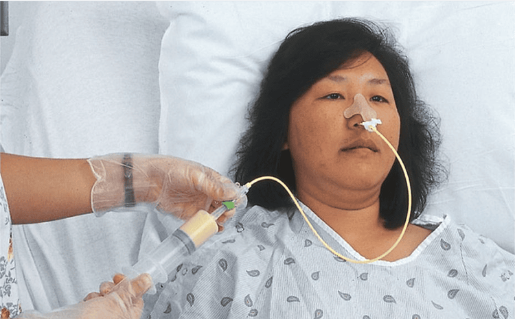 
Người bệnh được nuôi ăn qua ống sonde tại nhà
