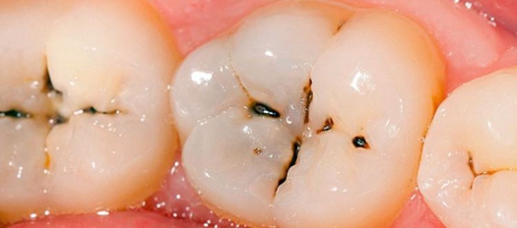 Chữa sâu răng cũng giảm được các triệu chứng của chảy máu chân răng