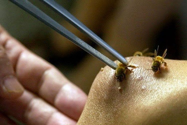 Vị trí ong đốt và số lượng vết đốt ảnh hưởng đến quá trình điều trị và tiên lượng