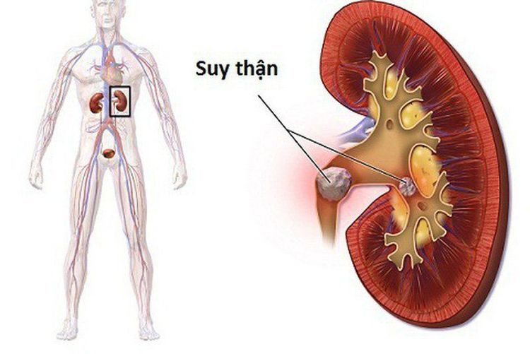 
Sỏi niệu quản có thể gây suy thận nếu không được điều trị sớm
