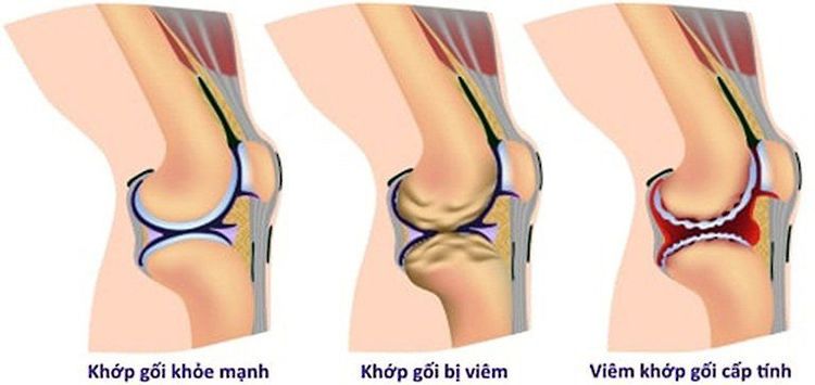 Bệnh nhân viêm khớp gối có thể sử dụng gậy để hỗ trợ giảm tải cho khớp gối
