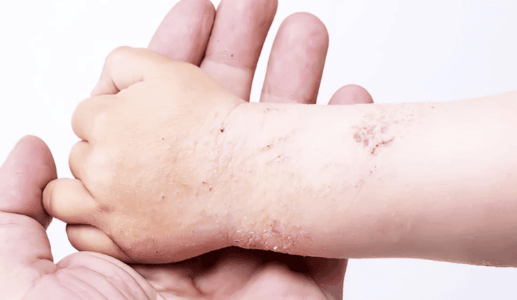 Vảy phấn dạng lichen mãn tính là bệnh lành tính tiến triển kéo dài, tái phát liên tục