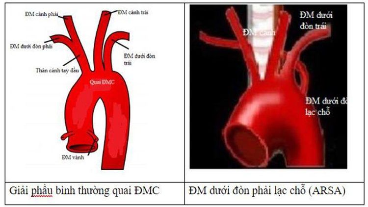 Hình ảnh quai động mạch chủ có 4 nhánh