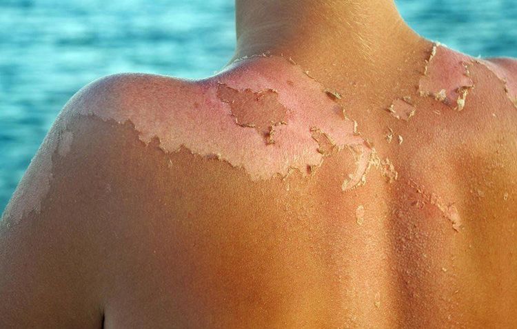 Tomatoes can help reduce skin irritation