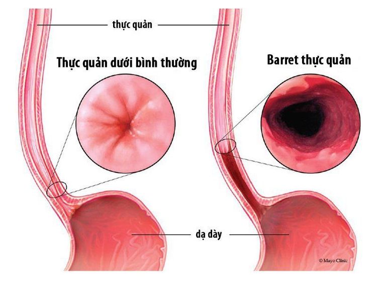 Hình ảnh Barrett thực quản