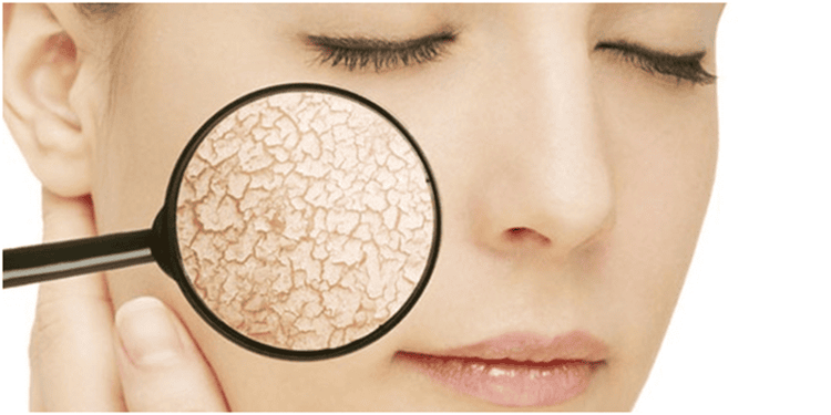Tomatoes serve to moisturize dry skin