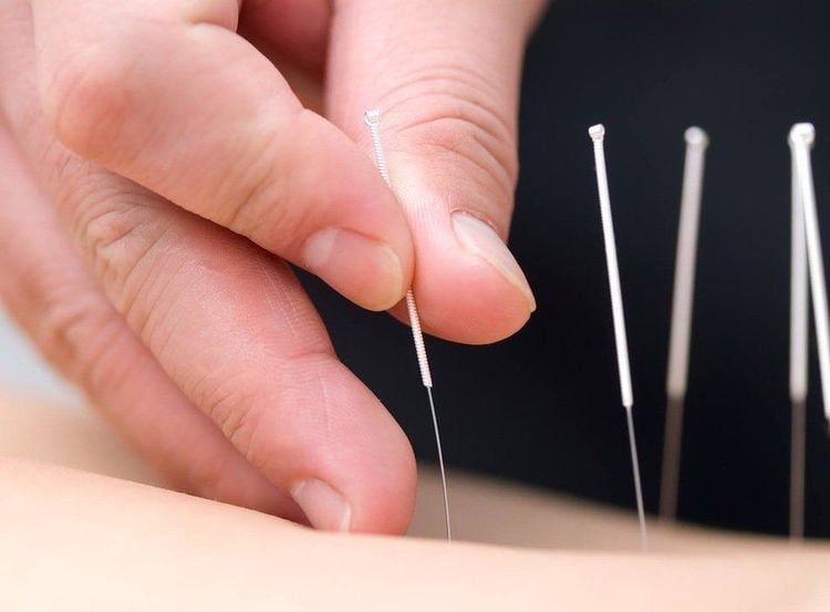 
Studies show that 12 acupuncture sessions can significantly reduce menstrual pain for up to a year