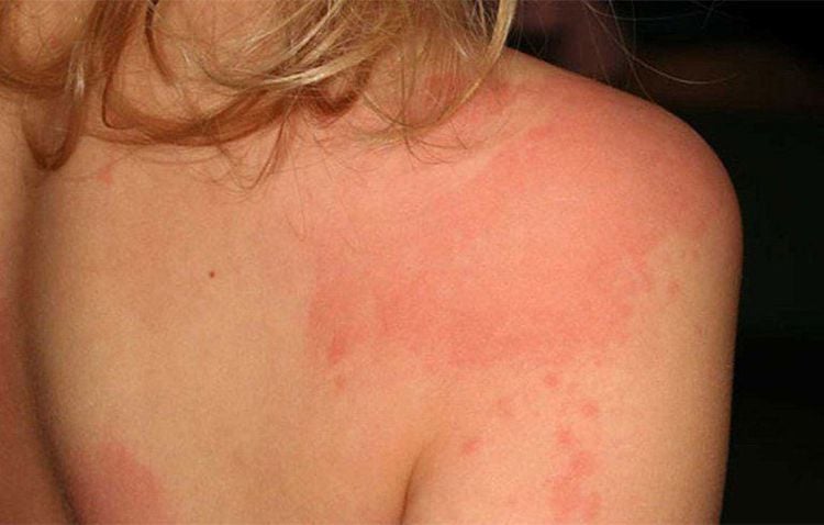 Patients should also not self-medicate with antibiotic ointments as some may cause skin rashes.