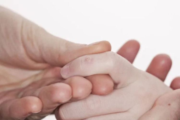 Phát hiện các trường hợp mụn cóc ở trẻ sơ sinh thông qua hình dạng