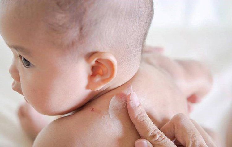 Cha mẹ có thể thoa kem dưỡng ẩm cho trẻ bị khô da