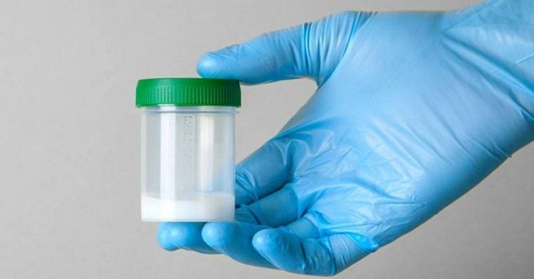Semen is a combination of mature sperm and prostatic fluid.