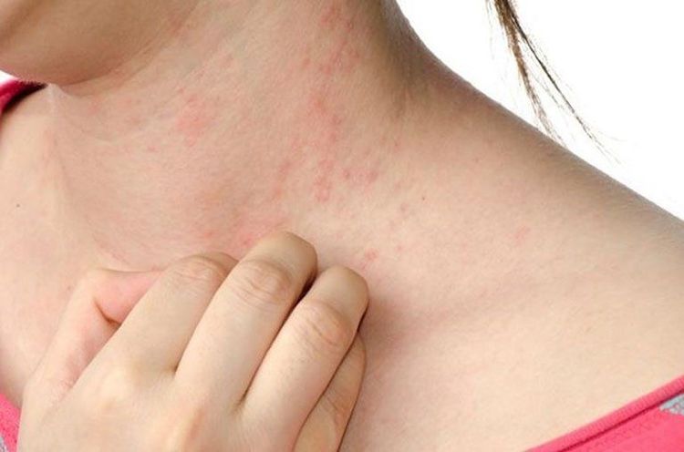 Các tác dụng phụ khi dùng thuốc aquanaz là các biểu hiện của phản ứng dị ứng ngứa da, nổi hồng ban trên da
