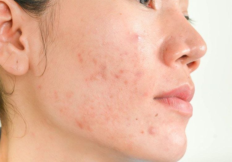 Hormonal changes due to PCOS can cause various symptoms, including increased acne.