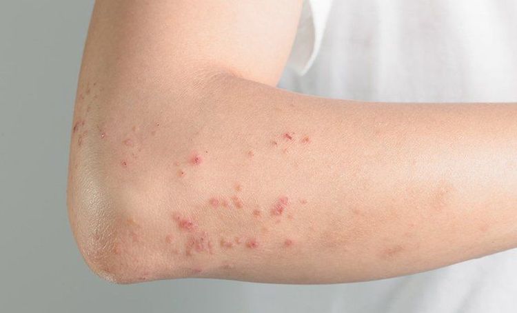 Amoxicillin có thể gây ra một số tác dụng phụ không mong muốn cho người bệnh