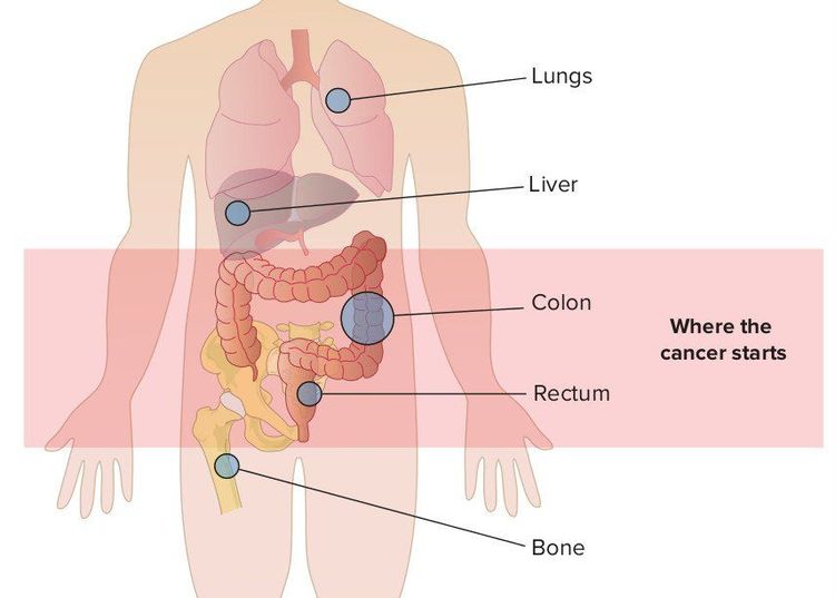 
Ung thư đại trực tràng di căn có nghĩa là nó đã lan đến các vị trí trong khu vực hoặc các cơ quan khác.
