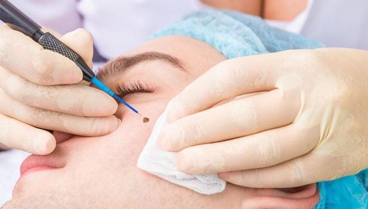 Some modern methods of mole removal include laser, cryotherapy and curettage.