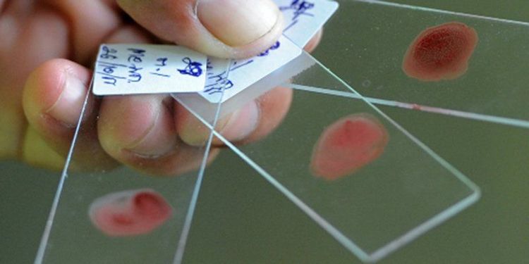 
Xét nghiệm sốt rét tiến hành đơn giản và dễ thực hiện
