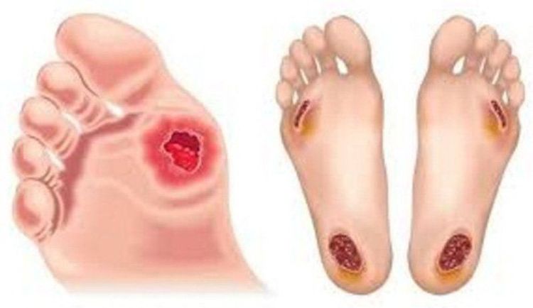 Nhiễm trùng bàn chân tiểu đường là tình trạng diễn ra phổ biến