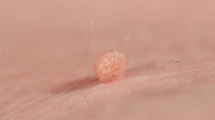 Condylox is applied directly on the genital warts