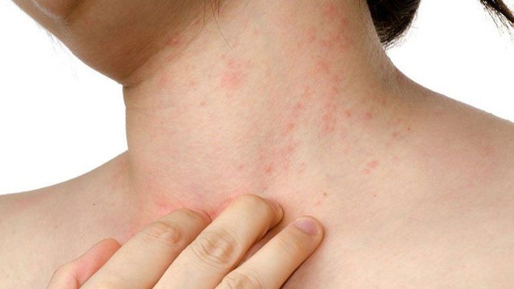 Thuốc ức chế sinh học điều trị viêm loét đại tràng có thể gây mẩn đỏ, ngứa,...