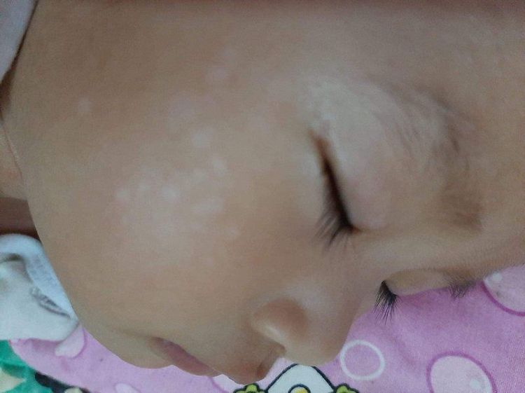 How to treat tinea versicolor on the face of a 10-month-old child?