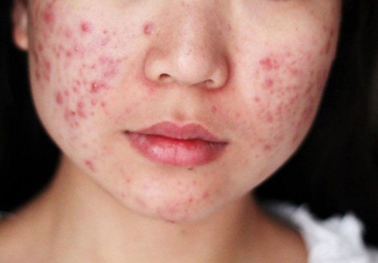 Lá hương nhu tía giúp cải thiện tình trạng mụn trứng cá, kích ứng da