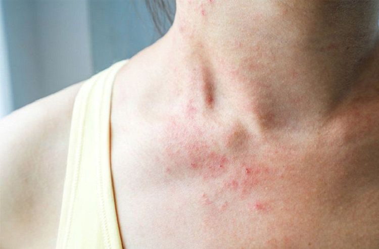 Đeo khuyên tai khi ngủ tăng nguy cơ dị ứng với niken