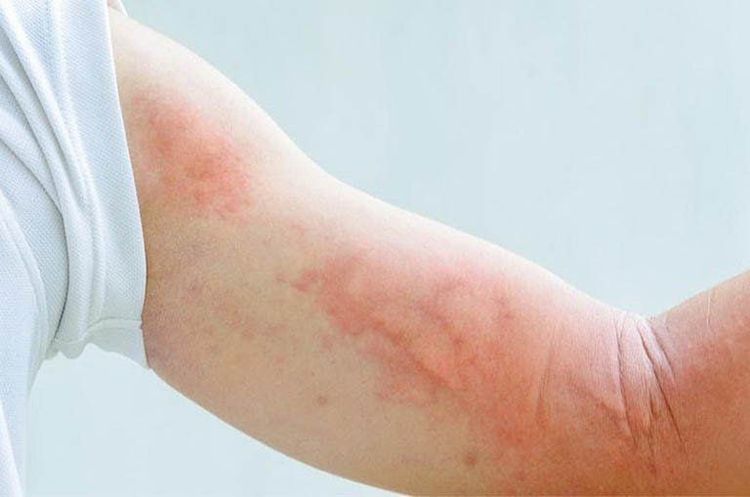Taking Tamsulosin can cause side effects such as rash and skin redness
