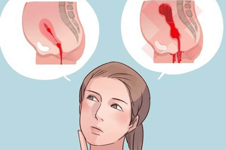 Bế sản dịch là một trong các nguyên nhân gây vết mổ sau sinh bị nhiễm trùng