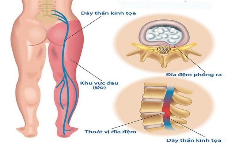 Thoát vị đĩa đệm là một trong các nguyên nhân gây đau thần kinh tọa