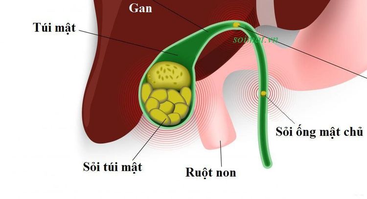 Nội soi mật tụy ngược dòng can thiệp cắt cơ thắt lô đường mật để lấy sỏi ống mật chủ